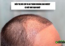 Điều trị hói chữ M giá thành khoảng bao nhiêu? Có đắt như bạn nghĩ?