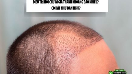 Điều trị hói chữ M giá thành khoảng bao nhiêu? Có đắt như bạn nghĩ?