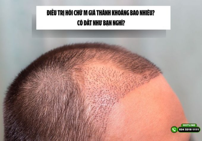 Điều trị hói chữ M giá thành khoảng bao nhiêu? Có đắt như bạn nghĩ?