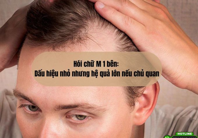 Hói chữ M 1 bên: Dấu hiệu nhỏ nhưng hệ quả lớn nếu chủ quan
