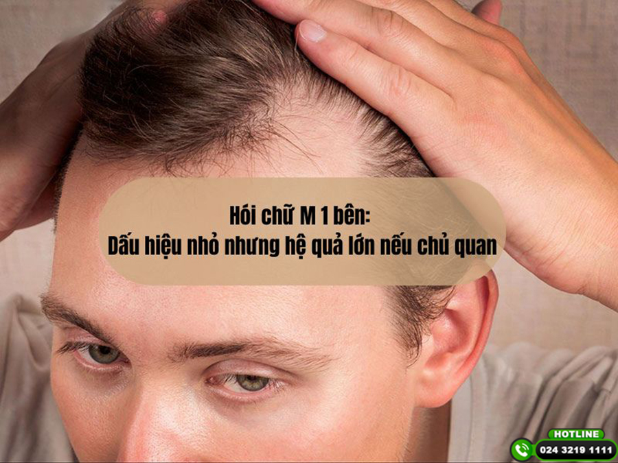 Hói chữ M 1 bên: Dấu hiệu nhỏ nhưng hệ quả lớn nếu chủ quan