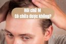 Hói chữ M có chữa được không? Câu trả lời từ bác sĩ chuyên khoa