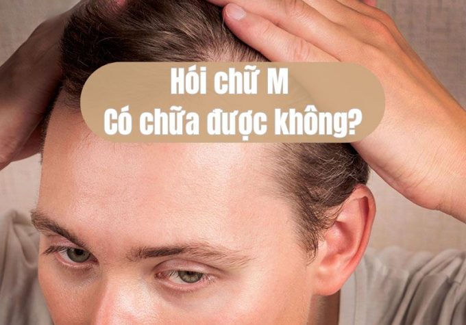 Hói chữ M có chữa được không? Câu trả lời từ bác sĩ chuyên khoa