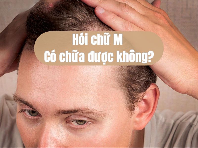 Hói chữ M có chữa được không? Câu trả lời từ bác sĩ chuyên khoa