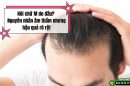 Hói chữ M do đâu? Nguyên nhân âm thầm nhưng hậu quả rõ rệt