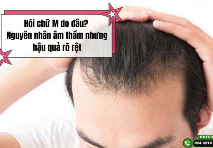 Hói chữ M do đâu? Nguyên nhân âm thầm nhưng hậu quả rõ rệt