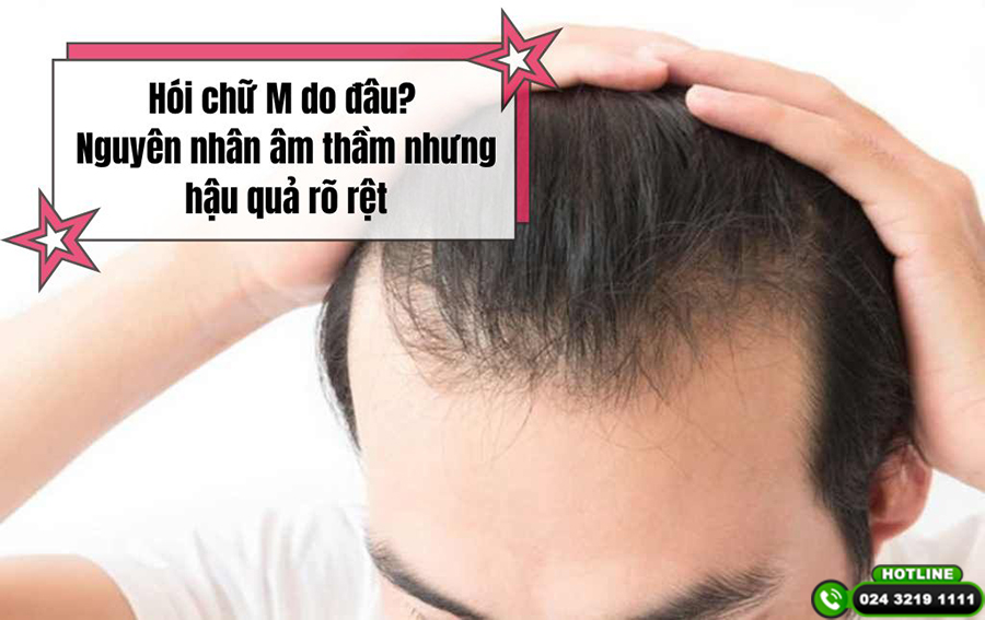 Hói chữ M do đâu? Nguyên nhân âm thầm nhưng hậu quả rõ rệt