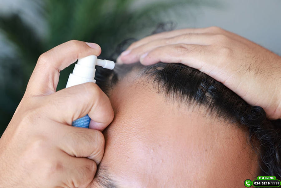 Bí quyết chữa hói đầu cho nam giúp tóc mọc trở lại tự nhiên