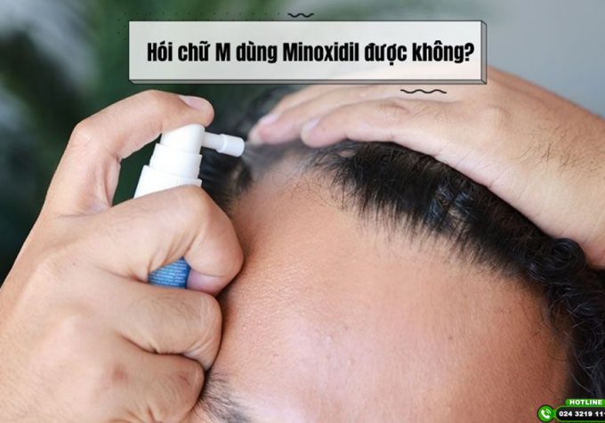 Hói chữ M dùng Minoxidil được không? Góc nhìn từ bác sĩ chuyên khoa