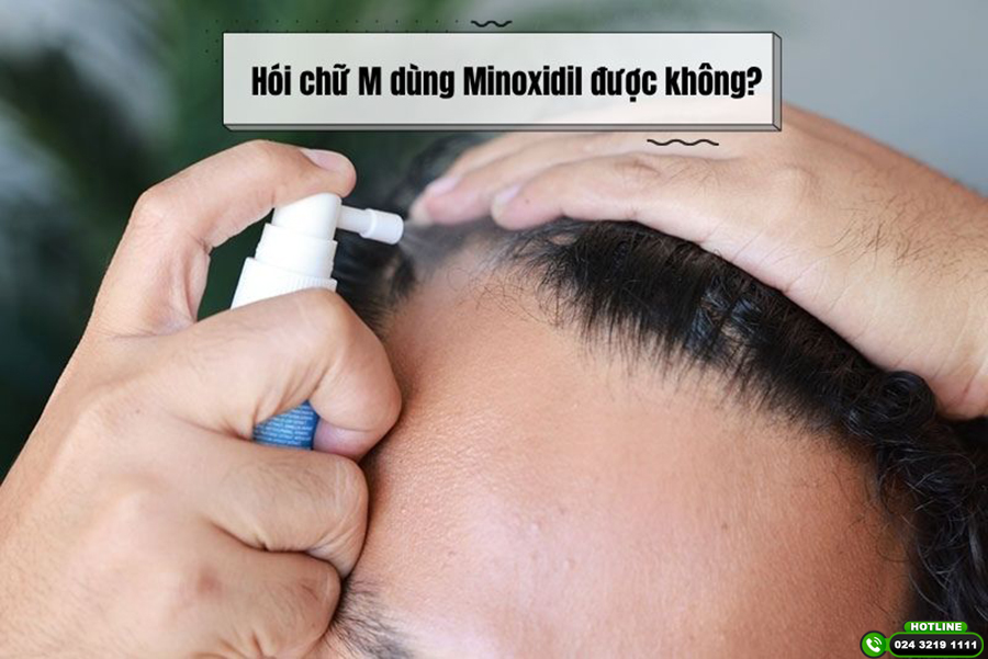 Hói chữ M dùng Minoxidil được không? Góc nhìn từ bác sĩ chuyên khoa