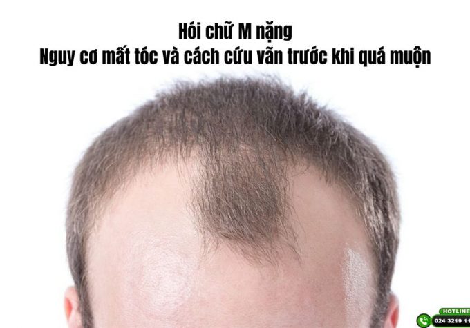 Hói chữ M nặng: Nguy cơ mất tóc và cách cứu vãn trước khi quá muộn