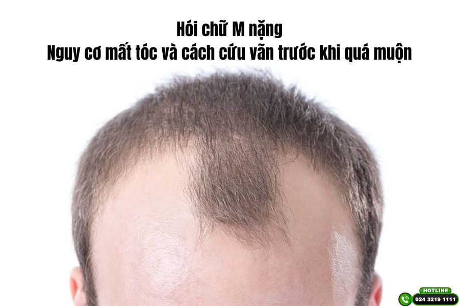 Hói chữ M nặng: Nguy cơ mất tóc và cách cứu vãn trước khi quá muộn