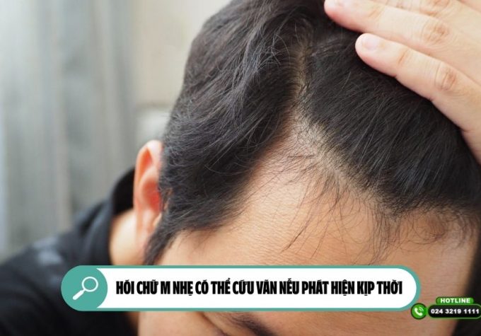 Hói chữ M nhẹ có thể cứu vãn nếu phát hiện kịp thời