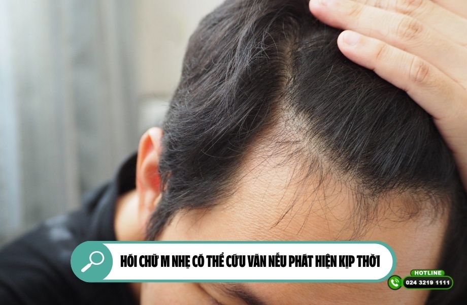 Hói chữ M nhẹ có thể cứu vãn nếu phát hiện kịp thời