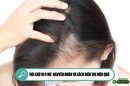 Hói chữ M ở nữ: Nguyên nhân và cách điều trị hiệu quả