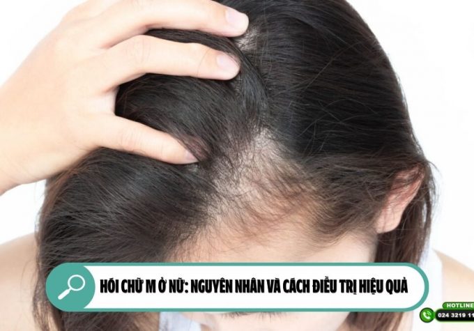 Hói chữ M ở nữ: Nguyên nhân và cách điều trị hiệu quả