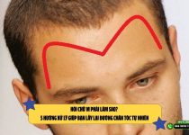 Hói chữ M phải làm sao? 5 hướng xử lý giúp bạn lấy lại đường chân tóc tự nhiên