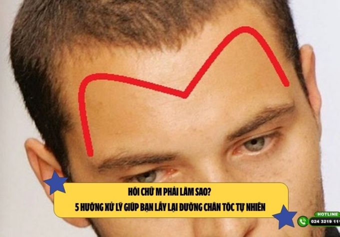 Hói chữ M phải làm sao? 5 hướng xử lý giúp bạn lấy lại đường chân tóc tự nhiên