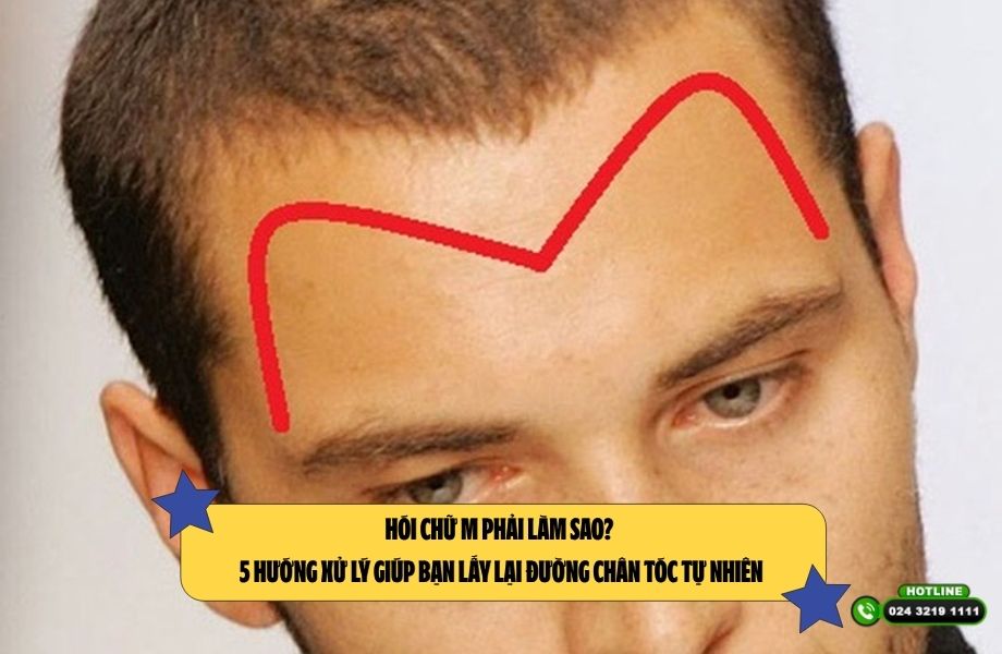 Hói chữ M phải làm sao? 5 hướng xử lý giúp bạn lấy lại đường chân tóc tự nhiên