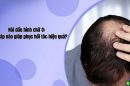 Hói đầu hình chữ O: Giải pháp nào giúp phục hồi tóc hiệu quả?