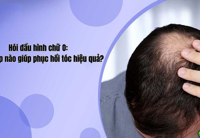Hói đầu hình chữ O: Giải pháp nào giúp phục hồi tóc hiệu quả?