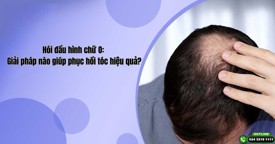 Hói đầu hình chữ O: Giải pháp nào giúp phục hồi tóc hiệu quả?