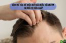 Làm thế nào để nhận biết dấu hiệu hói chữ M và điều trị hiệu quả?