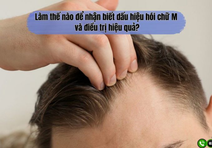 Làm thế nào để nhận biết dấu hiệu hói chữ M và điều trị hiệu quả?