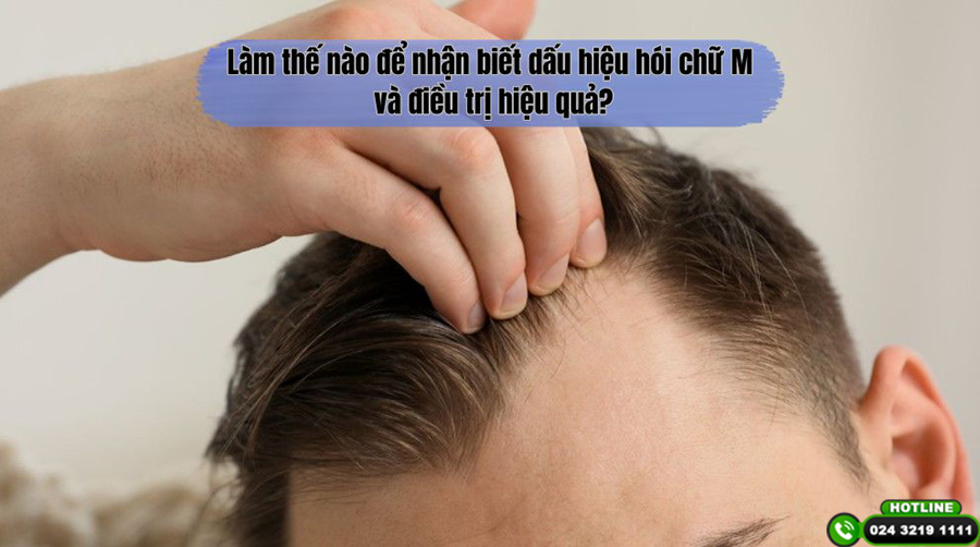 Làm thế nào để nhận biết dấu hiệu hói chữ M và điều trị hiệu quả?