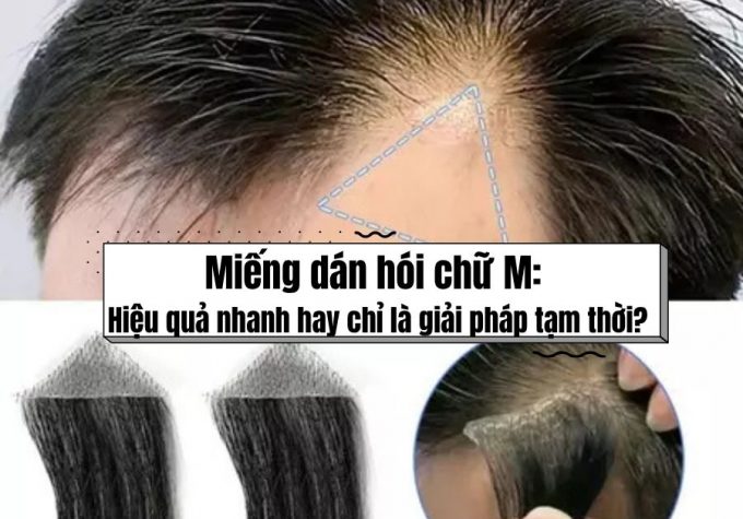 Miếng dán hói chữ M: Hiệu quả nhanh hay chỉ là giải pháp tạm thời?