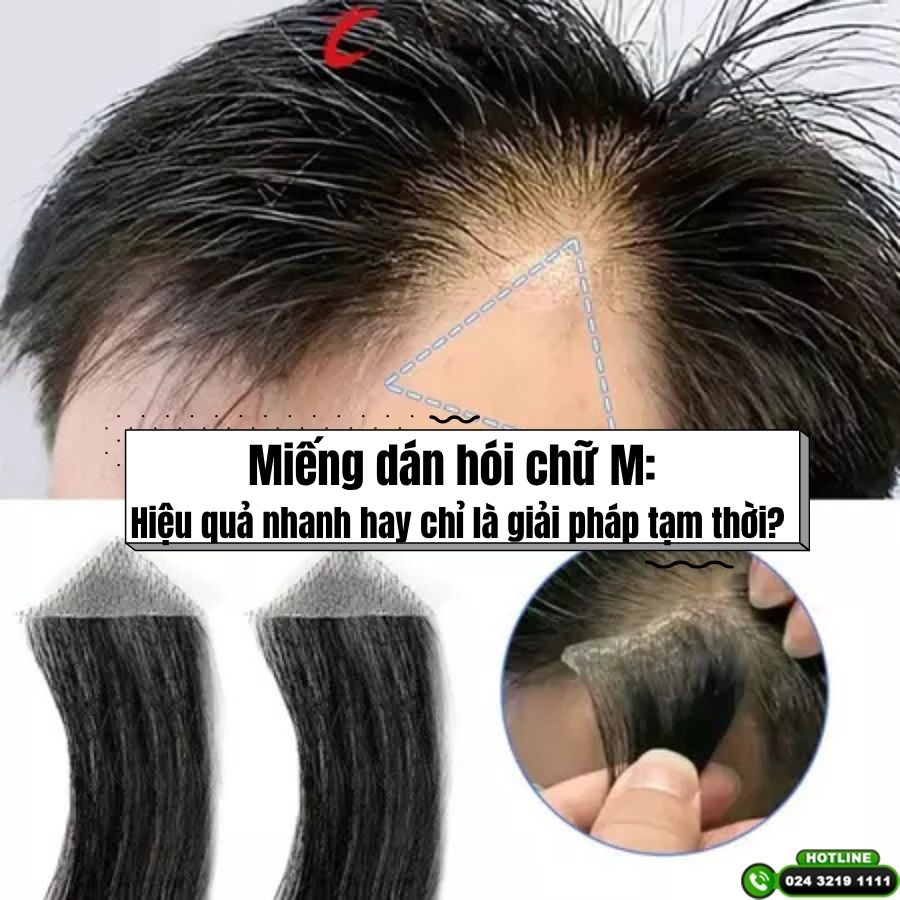 Miếng dán hói chữ M: Hiệu quả nhanh hay chỉ là giải pháp tạm thời?