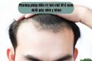 Phương pháp điều trị hói chữ M ở nam dưới góc nhìn y khoa