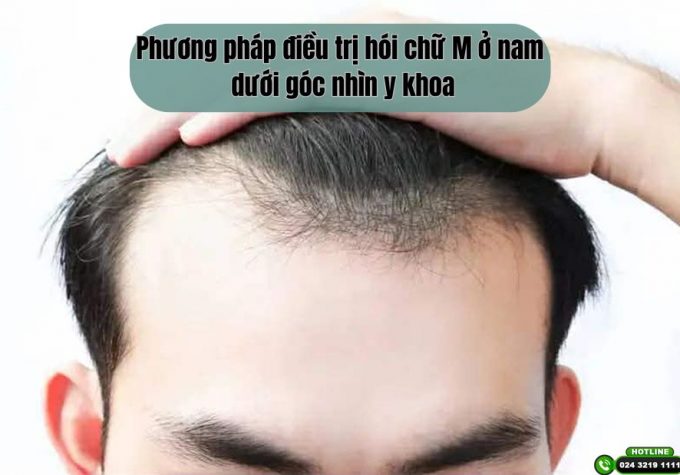 Phương pháp điều trị hói chữ M ở nam dưới góc nhìn y khoa