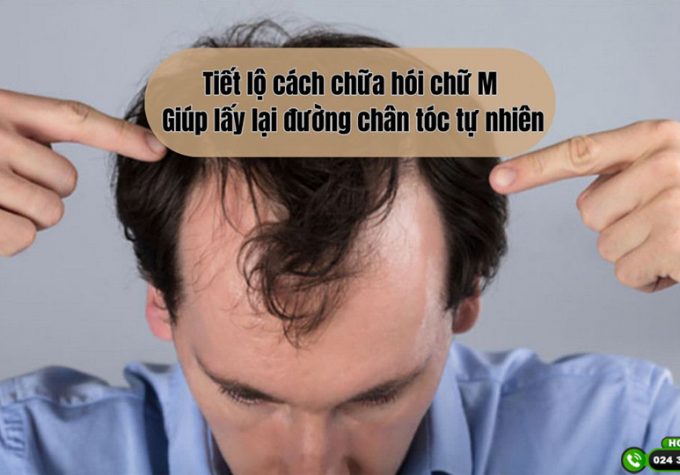 Tiết lộ cách chữa hói chữ M giúp lấy lại đường chân tóc tự nhiên