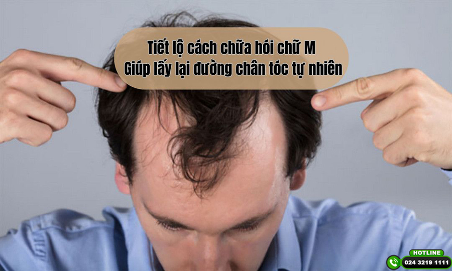 Tiết lộ cách chữa hói chữ M giúp lấy lại đường chân tóc tự nhiên