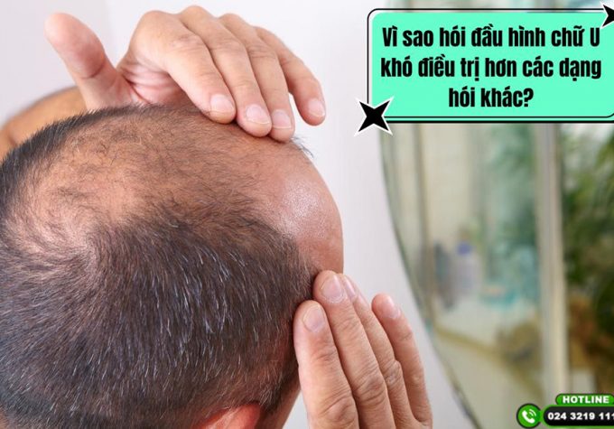 Vì sao hói đầu hình chữ U khó điều trị hơn các dạng hói khác?