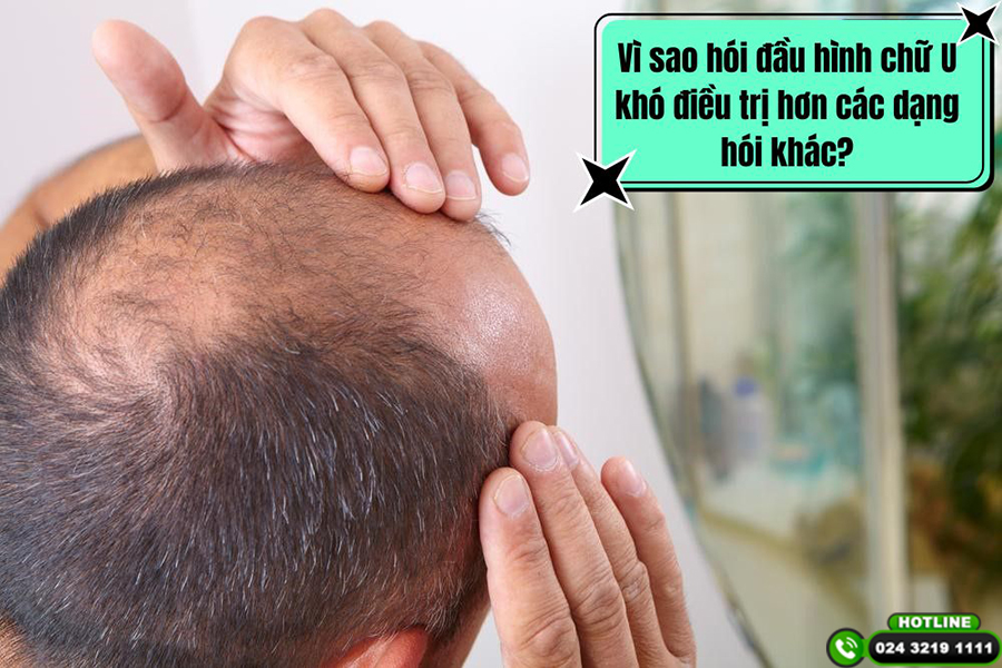 Vì sao hói đầu hình chữ U khó điều trị hơn các dạng hói khác?