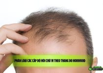 Phân loại các cấp độ hói chữ M theo thang đo Norwood