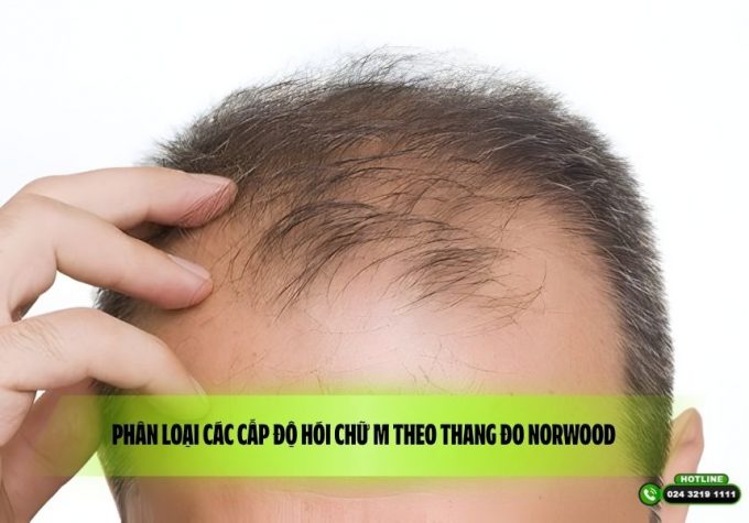 Phân loại các cấp độ hói chữ M theo thang đo Norwood