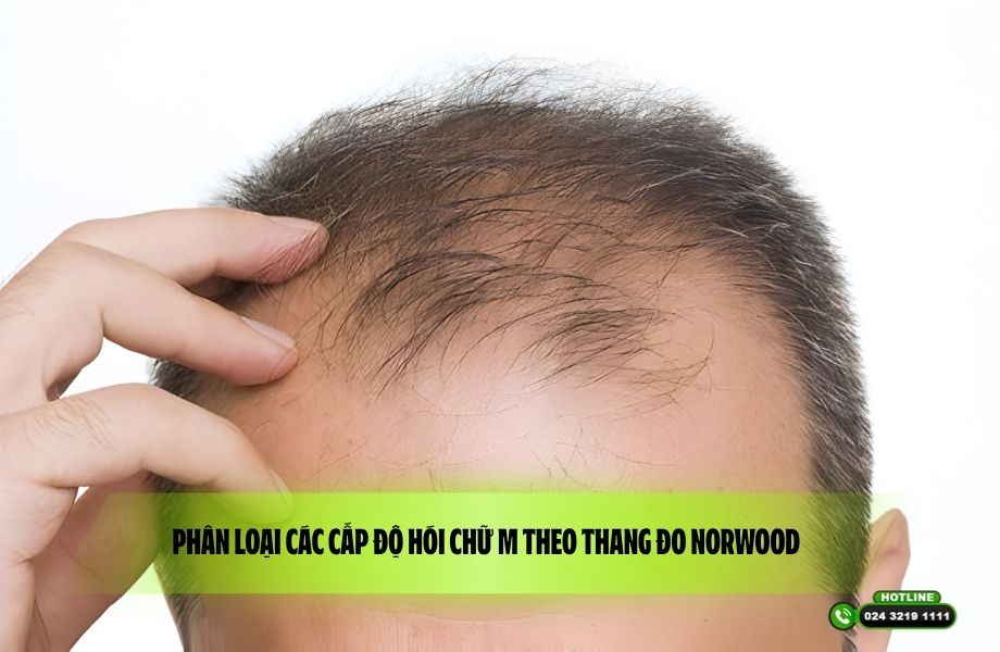 Phân loại các cấp độ hói chữ M theo thang đo Norwood