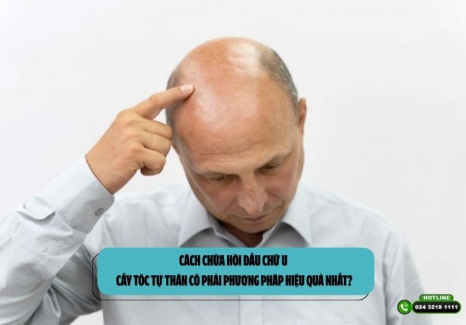 Cách chữa hói đầu chữ U: Cấy tóc tự thân có phải phương pháp hiệu quả nhất?