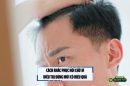 Cách khắc phục hói chữ M: Điều trị đúng mới có hiệu quả