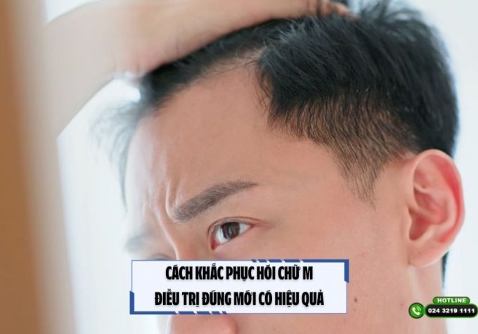 Cách khắc phục hói chữ M: Điều trị đúng mới có hiệu quả