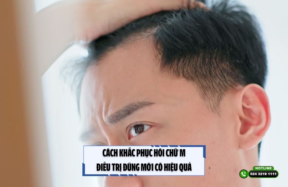 Cách khắc phục hói chữ M: Điều trị đúng mới có hiệu quả