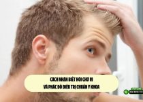 Cách nhận biết hói chữ M và phác đồ điều trị chuẩn y khoa 