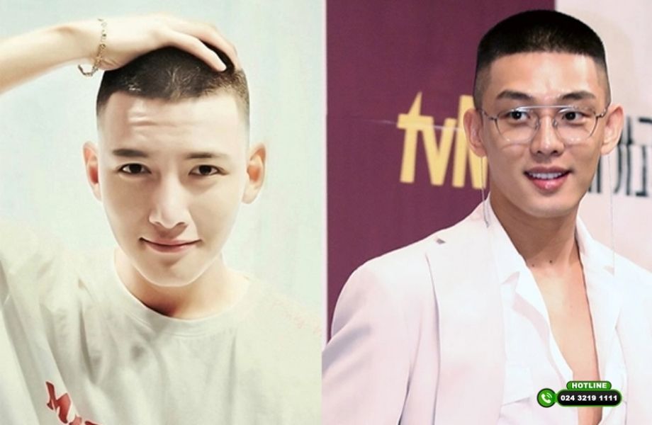 Kiểu tóc cho người hói chữ O: Che được khuyết điểm không hay chỉ là giải pháp tạm thời?