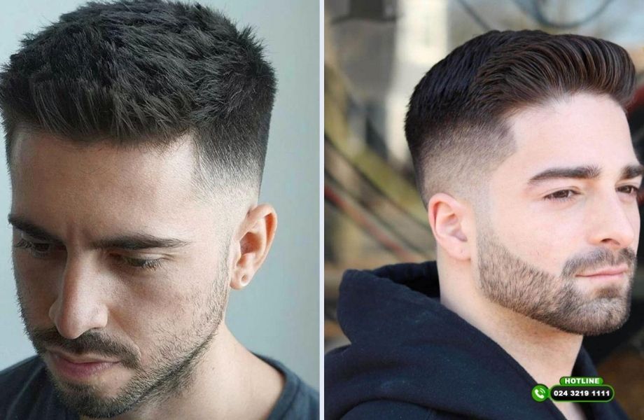 Kiểu tóc cho người hói chữ O: Che được khuyết điểm không hay chỉ là giải pháp tạm thời?