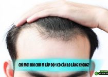 Chỉ mới hói chữ M cấp độ 1 có cần lo lắng không?