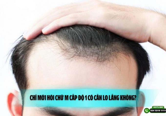 Chỉ mới hói chữ M cấp độ 1 có cần lo lắng không?