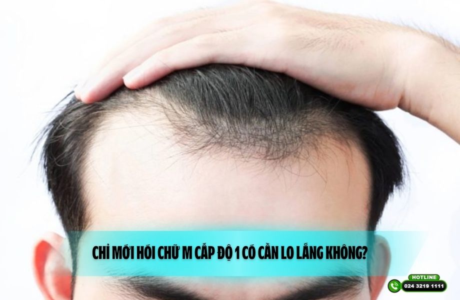 Chỉ mới hói chữ M cấp độ 1 có cần lo lắng không?